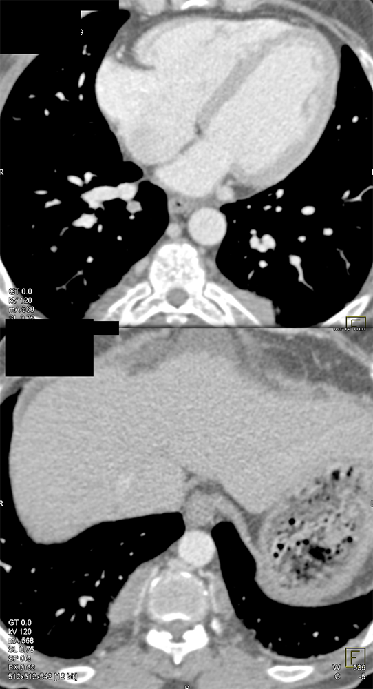 Mediastinum