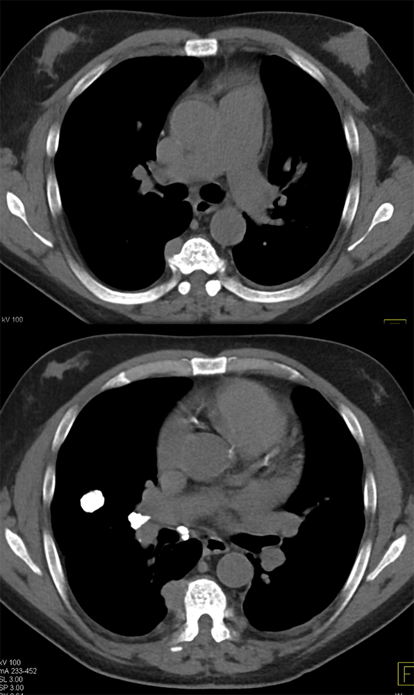 Extramedullary Hematopoeisis in Beta Thalassemia