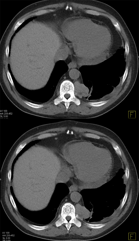 Extramedullary Hematopoeisis in Beta Thalassemia
