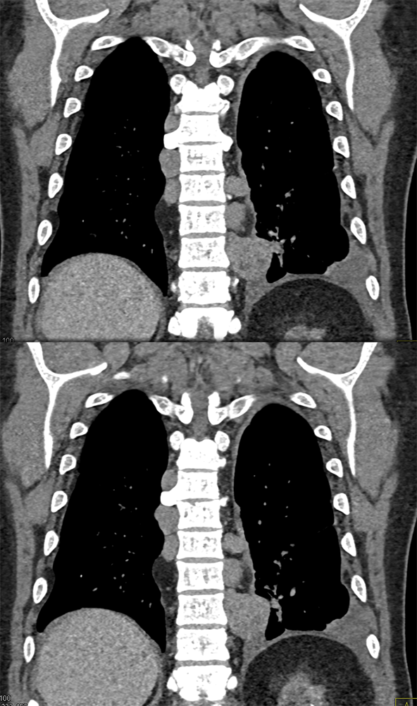 Extramedullary Hematopoeisis in Beta Thalassemia
