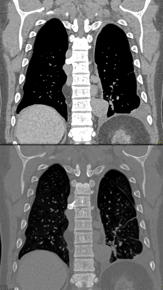 Extramedullary Hematopoeisis in Beta Thalassemia