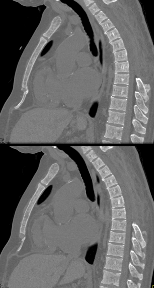 Extramedullary Hematopoeisis in Beta Thalassemia
