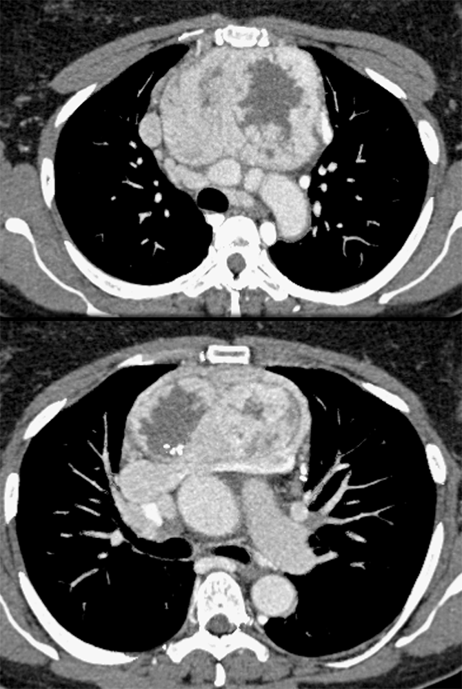 Substernal Thyroid in Anterior Mediastinum