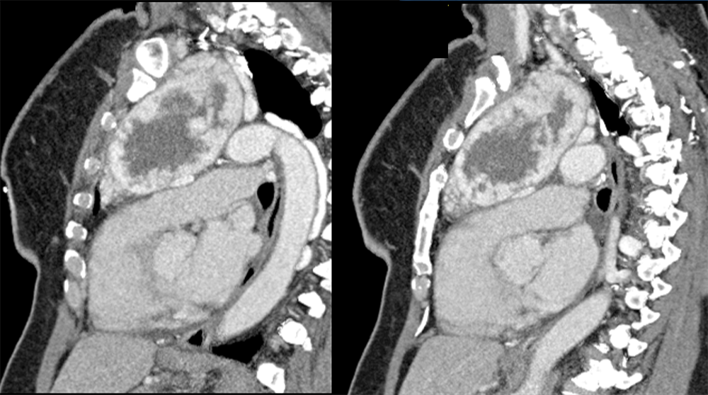 Substernal Thyroid in Anterior Mediastinum