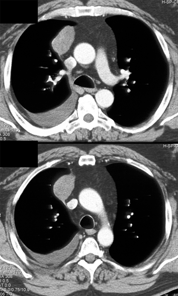 Thymoma