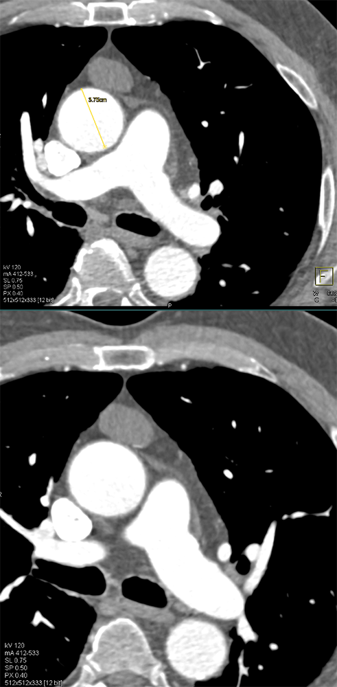 Thymoma