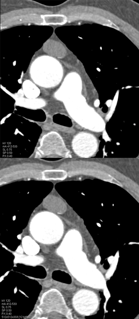 Thymoma