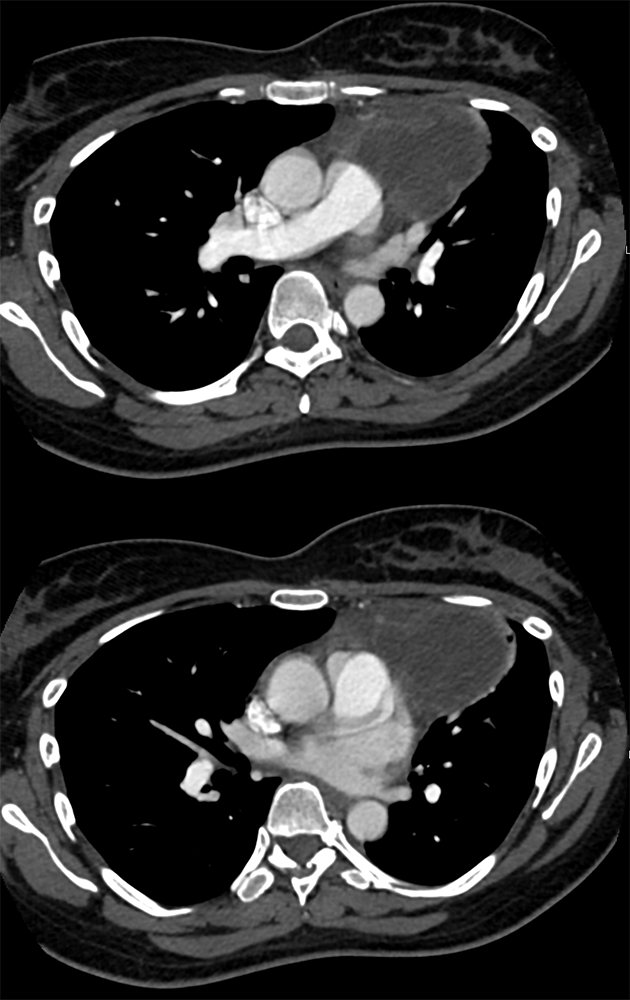 Cystic Thymoma