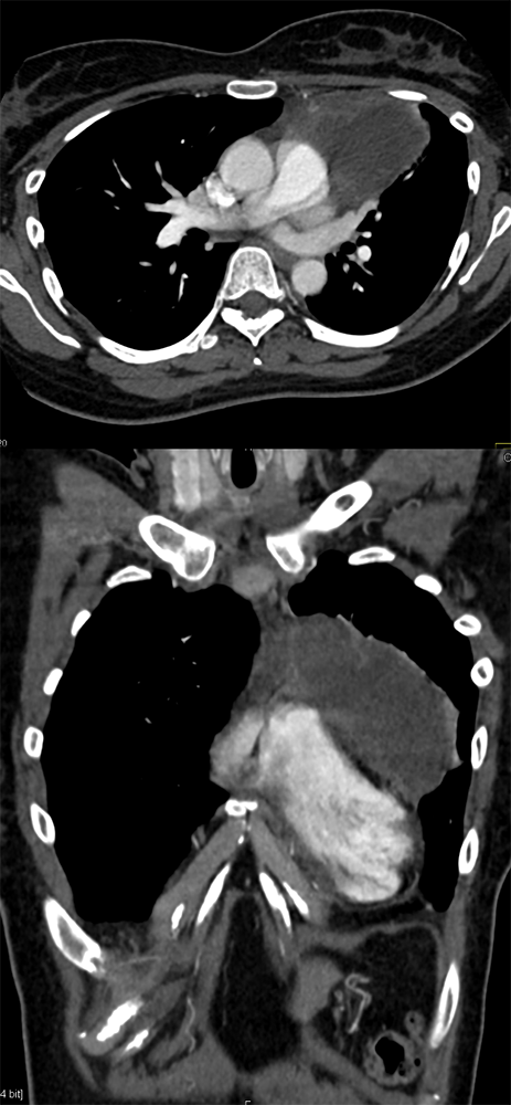 Cystic Thymoma