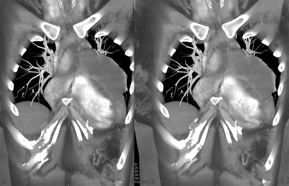 Cystic Thymoma