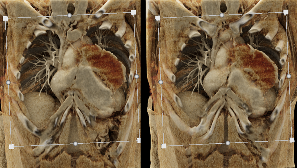 Cystic Thymoma