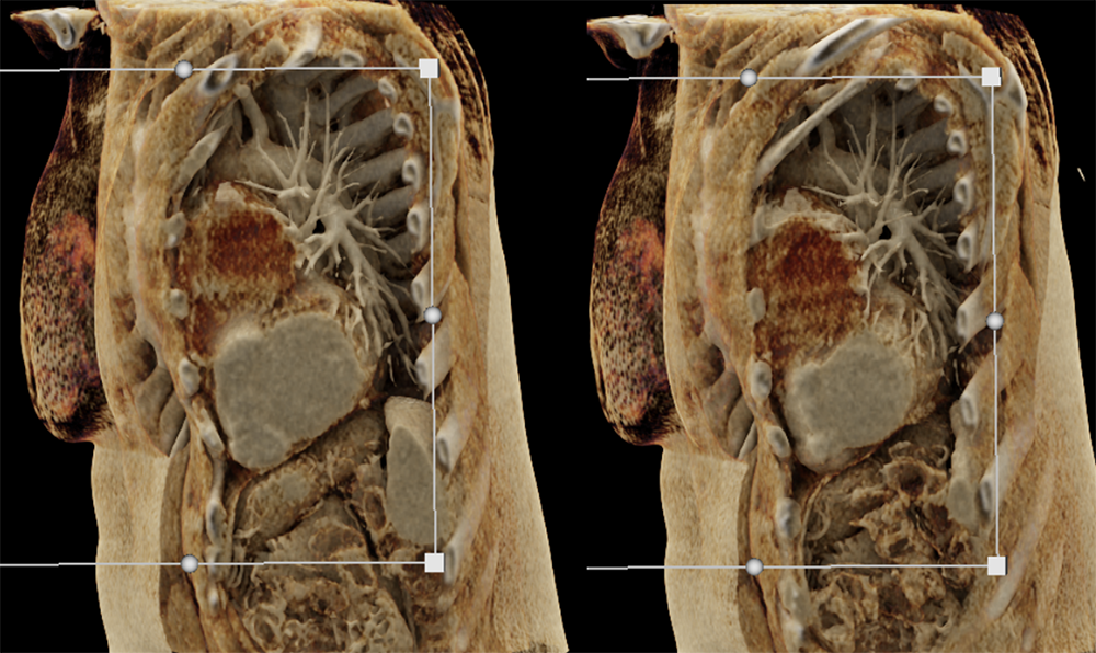 Cystic Thymoma