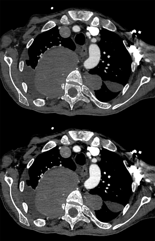 Mediastinal Widening on CXR