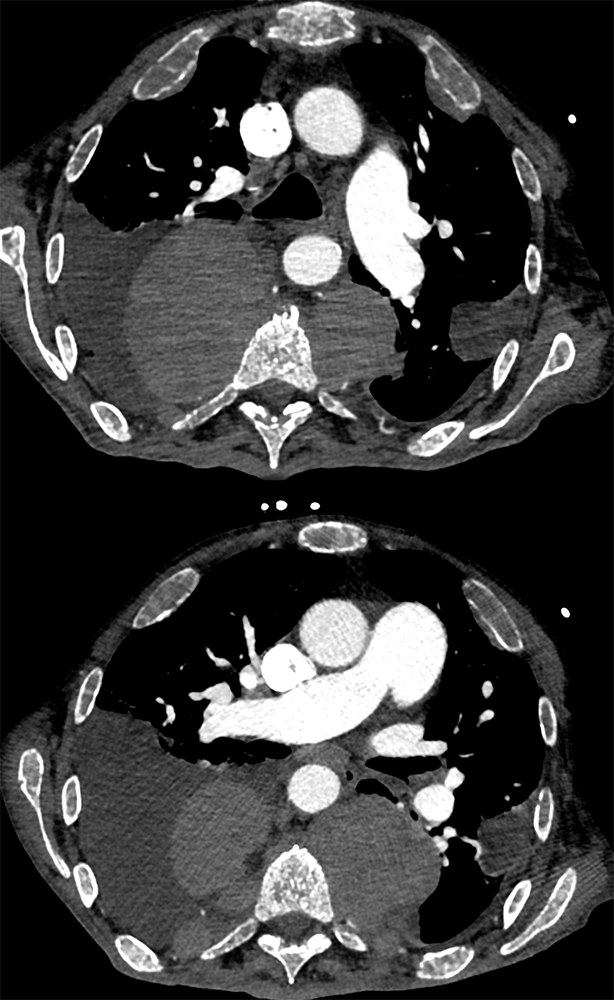 Mediastinal Widening on CXR