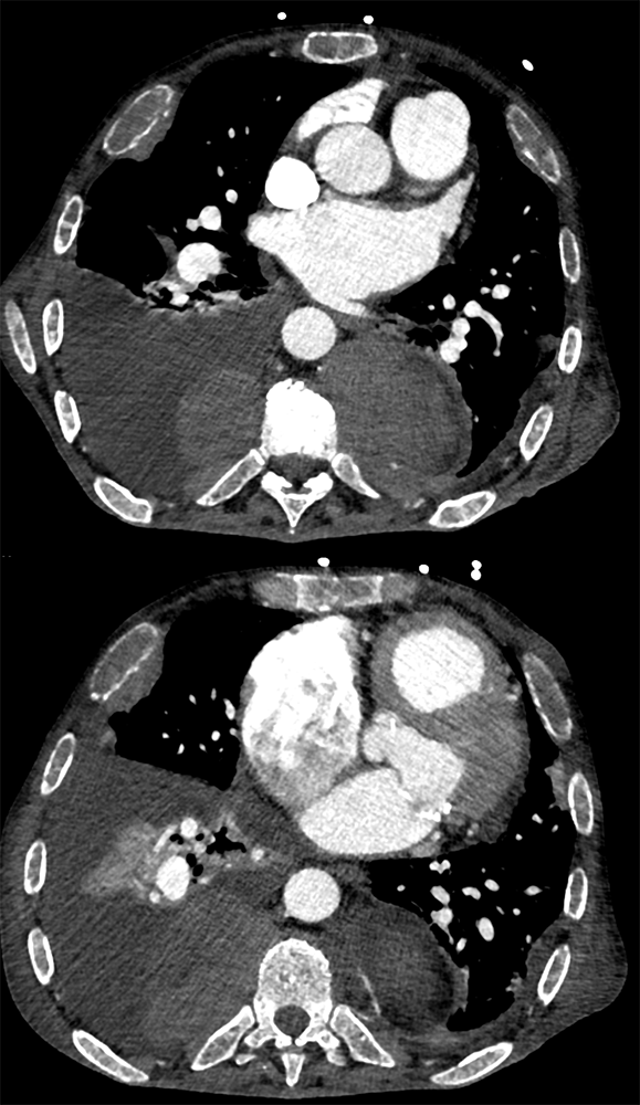 Mediastinal Widening on CXR