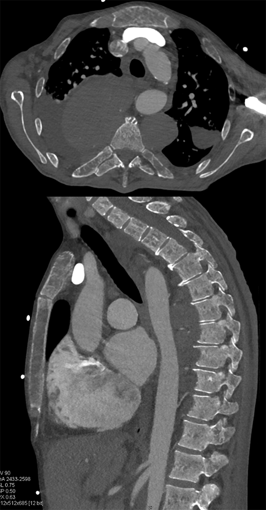 Mediastinal Widening on CXR