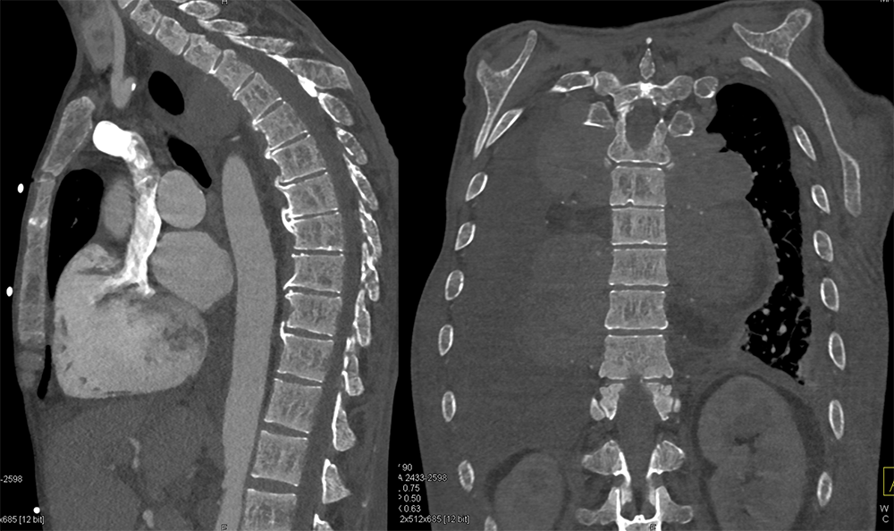 Mediastinal Widening on CXR