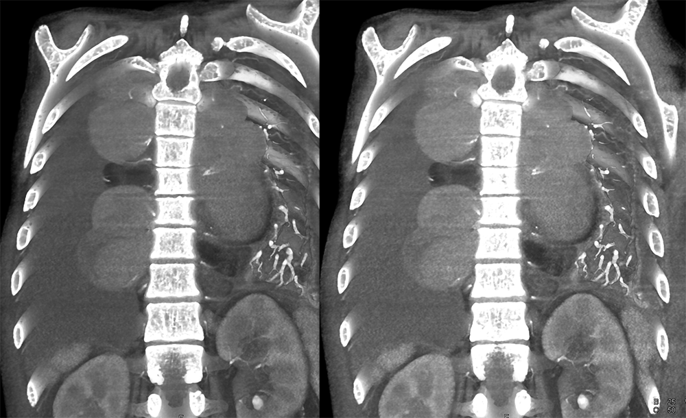 Mediastinal Widening on CXR