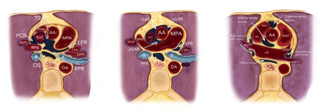 Pericardial Disease