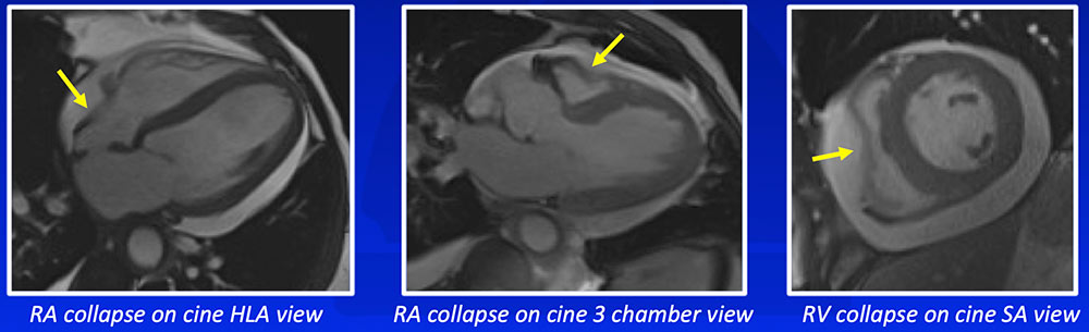Diastolic Collapse of RA and RV