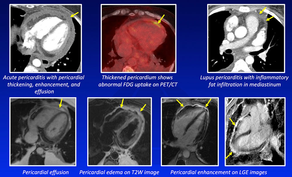 Acute Pericarditis
