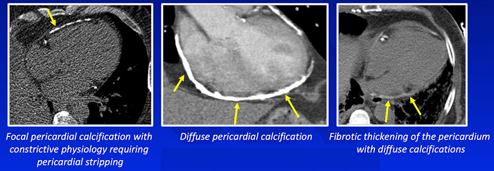 Chronic Calcific Pericarditis