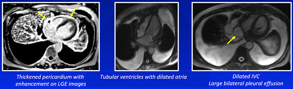 Morphologic Features of Constrictive Pericarditis
