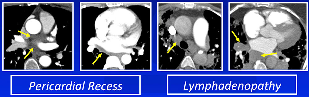 Clinical Importance of Pericardial Recesses