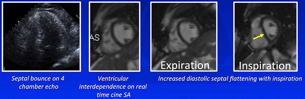 Ventricular Interdependence