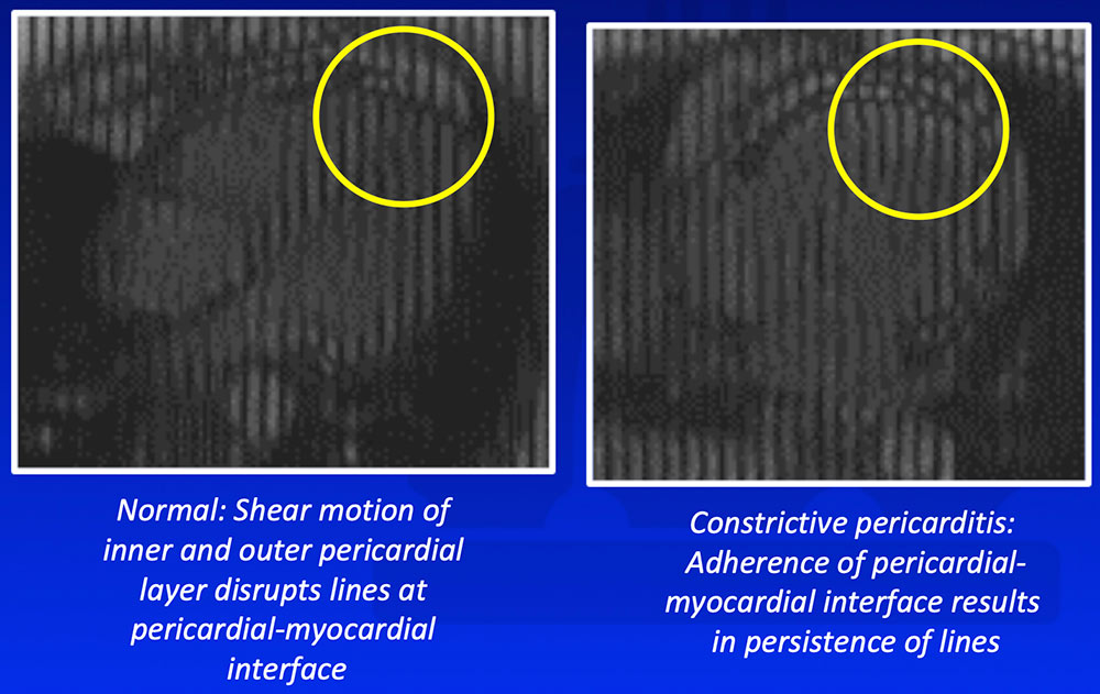 Pericardial-Myocardial Adherence