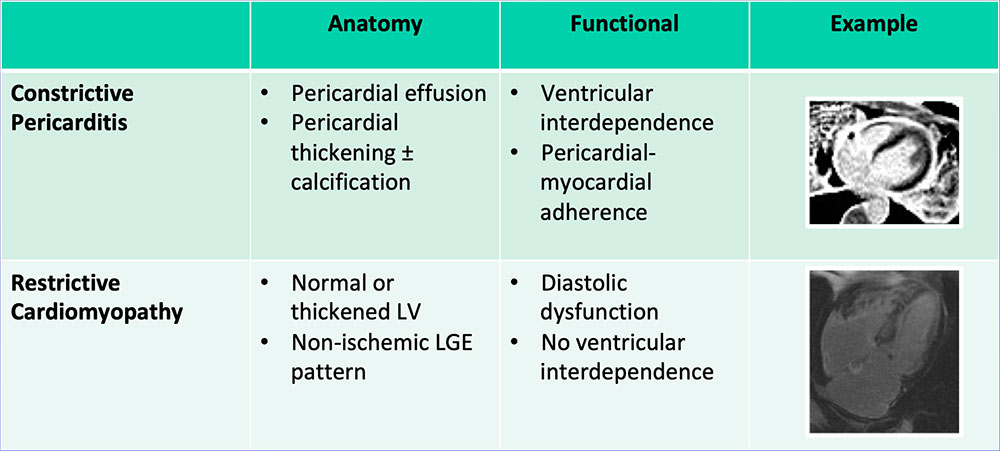 DDX: Restrictive Cardiomyopathy