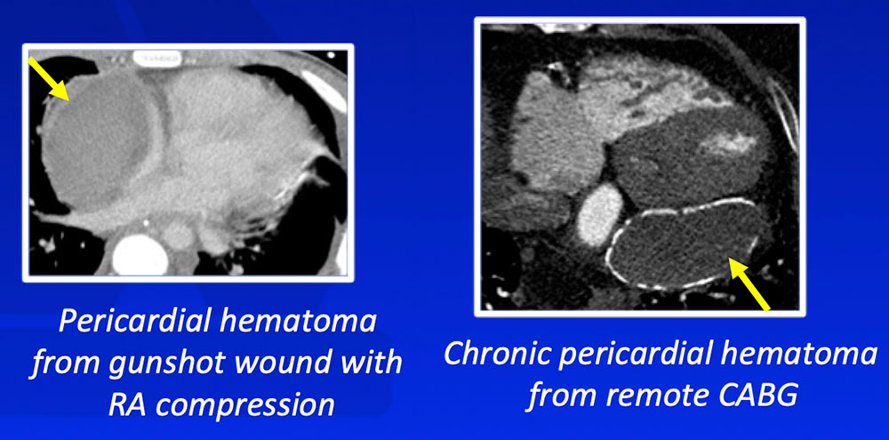 Pericardial Hematoma