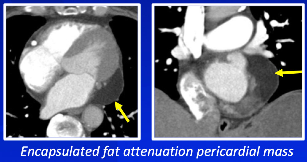 Pericardial Lipomatous Hypertrophy and Pericardial Lipoma