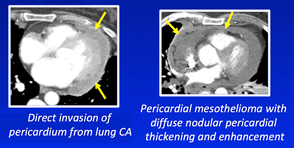 Malignant Pericardial Tumors