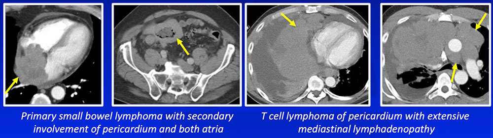 Pericardial Lymphoma