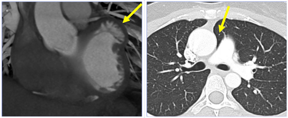Partial Absence of the Pericardium