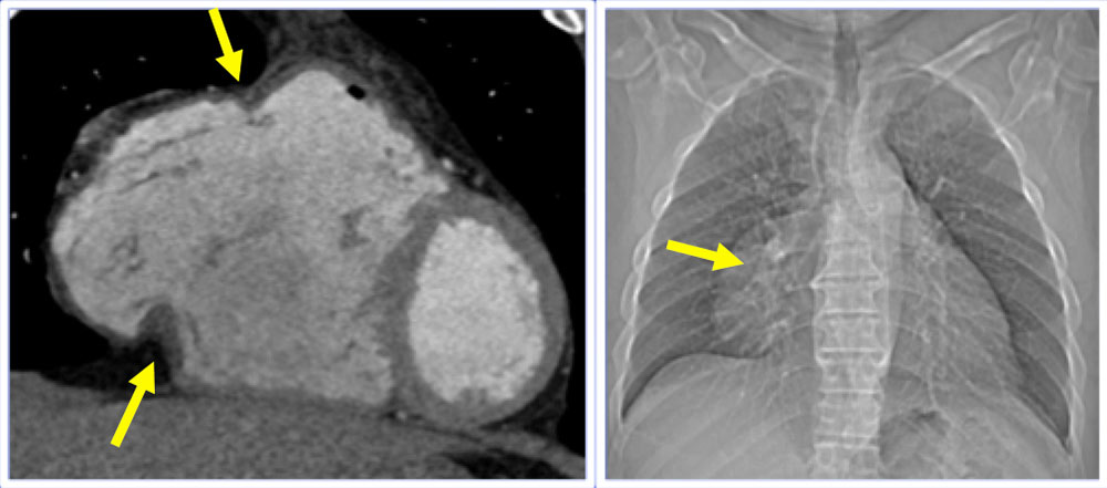 Partial Absence of the Pericardium
