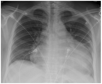 Pericardial Effusion