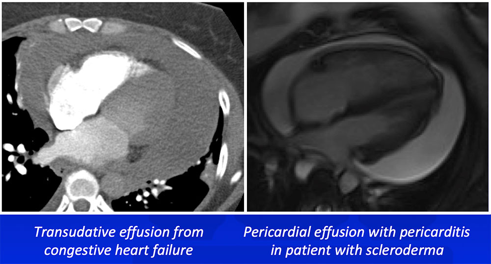 Transudative Pericardial Effusion