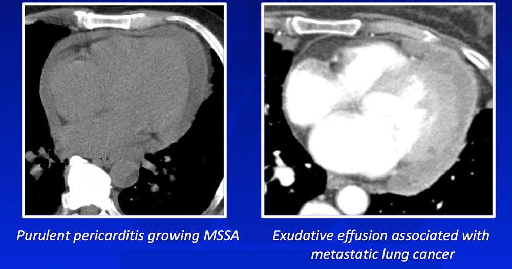 Exudative Pericardial Effusion
