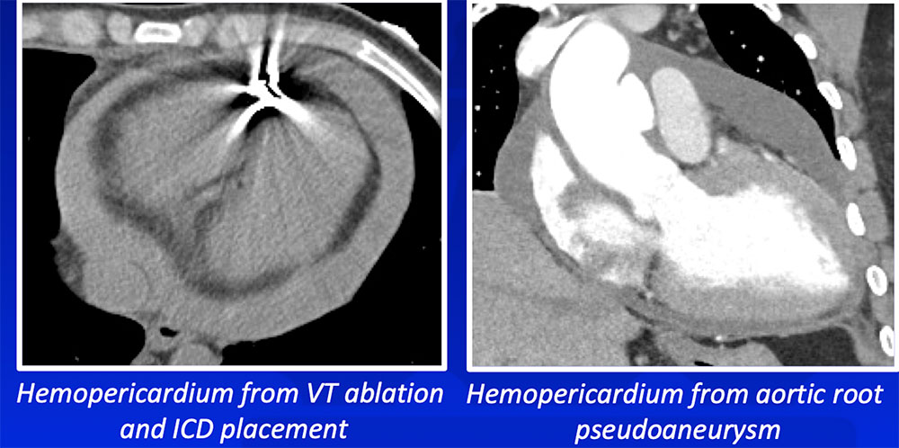 Hemopericardium