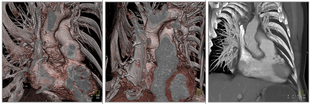 Case 2:Normal postoperative appearance in patient with valve-sparing operation