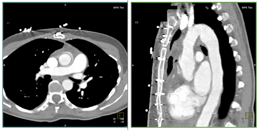 Case 3:Normal postoperative appearance in patient with valve-sparing operation