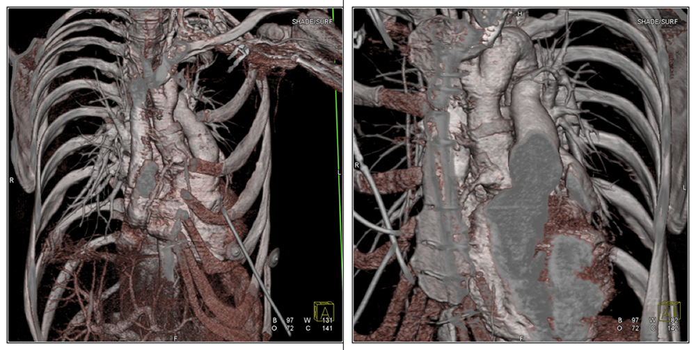 Case 3:Normal postoperative appearance in patient with valve-sparing operation