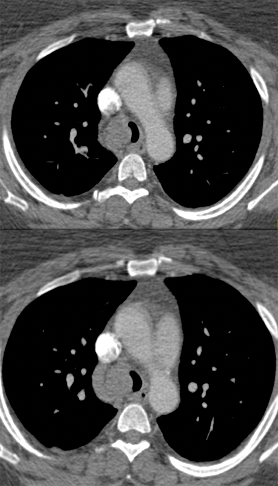 SOB and Hemoptysis