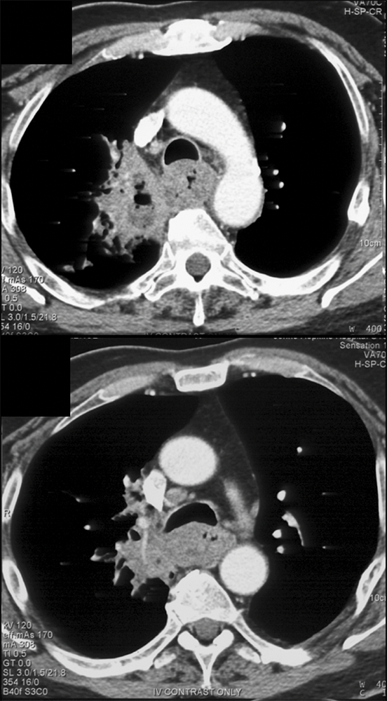 Esophageal Cancer Invades the Lung
