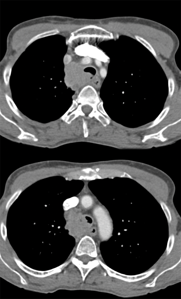 Metastatic Disease to Trachea
