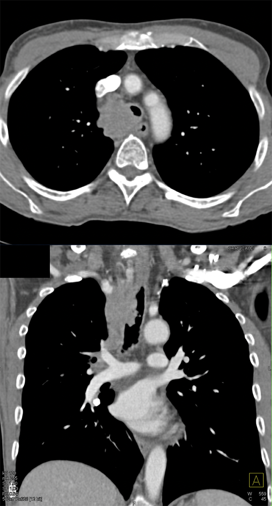 CT of the Trachea
