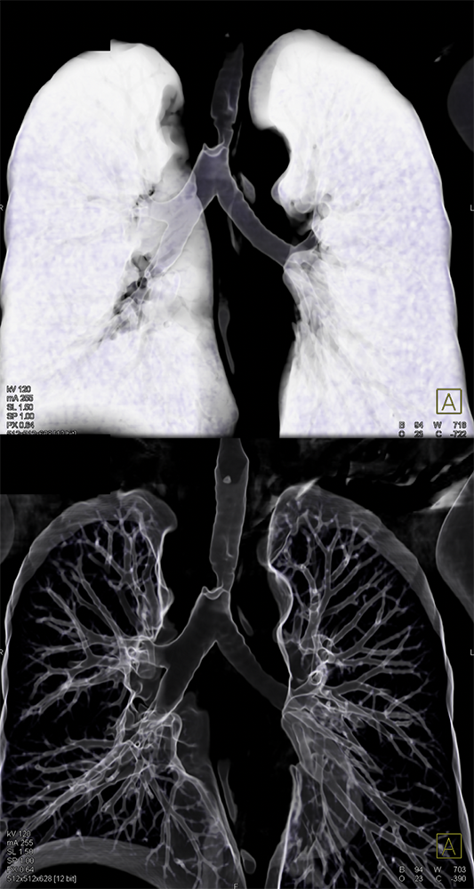 CT of the Trachea