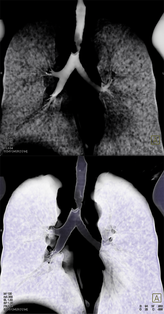 CT of the Trachea